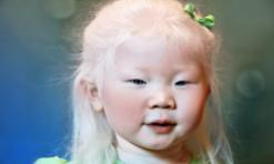 Albinisme oculo-cutané