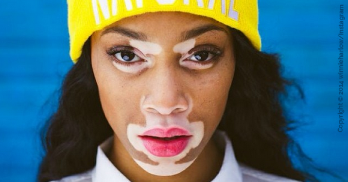 Chantelle-Brown-Model vitiligo